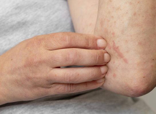 Fisioterapia en pacientes con Lupus Eritematoso Sistémico: Evidencia, enfoque digital y herramientas con TRAK